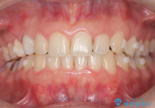 マウスピースで歯並びを改善の治療中