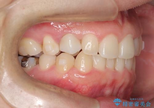 マウスピースで歯並びを改善の治療中