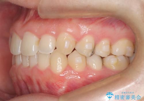 マウスピースで歯並びを改善の治療中