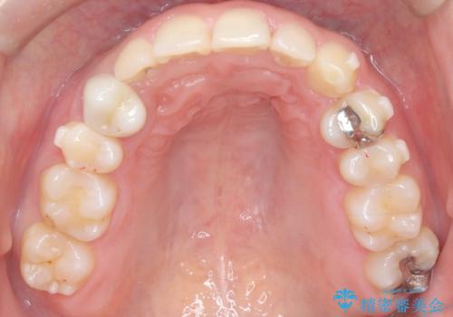 マウスピースで歯並びを改善の治療中