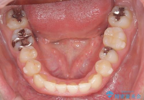 マウスピースで歯並びを改善の治療中