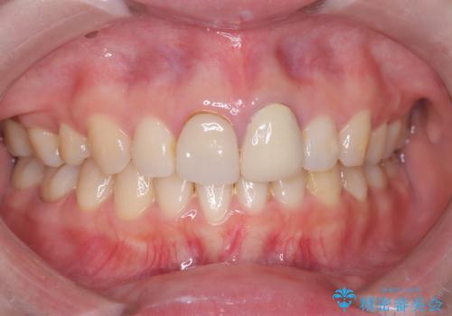 前歯の見た目と根の悩みを根本から解決の治療前