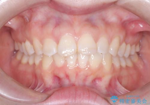 前歯のデコボコを、目立たない矯正で解消の治療後