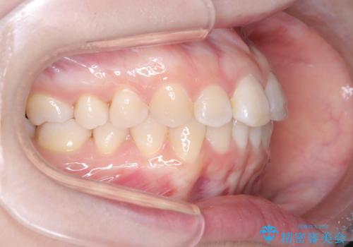 前歯のデコボコを、目立たない矯正で解消の治療後