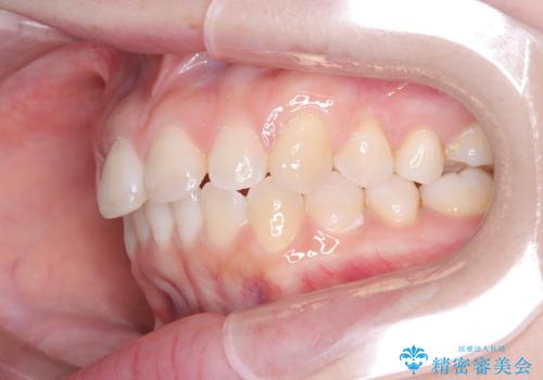 前歯のデコボコを、目立たない矯正で解消の治療後