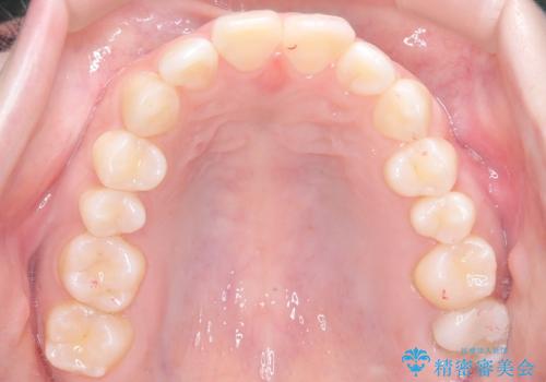 前歯のデコボコを、目立たない矯正で解消の治療後