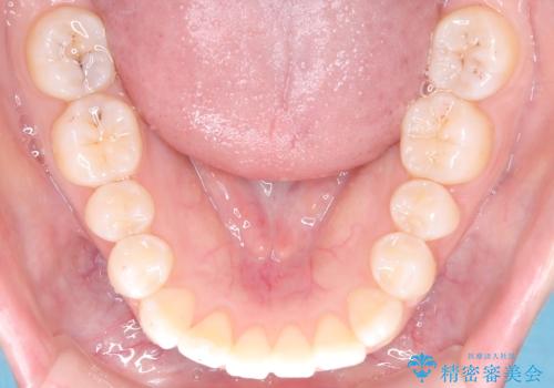 前歯のデコボコを、目立たない矯正で解消の治療後