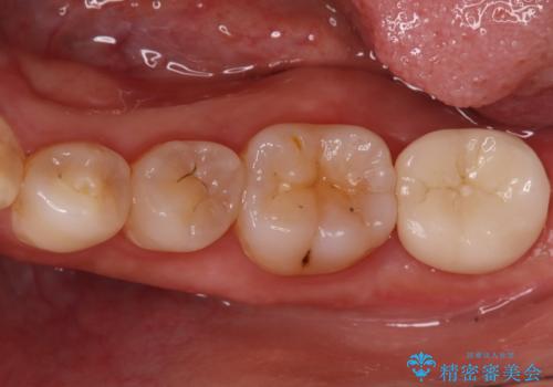 奥歯の激しい痛みを解消し、歯を長持ちさせる精密治療の症例 治療後