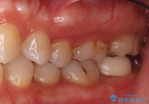 奥歯の激しい痛みを解消し、歯を長持ちさせる精密治療の治療後