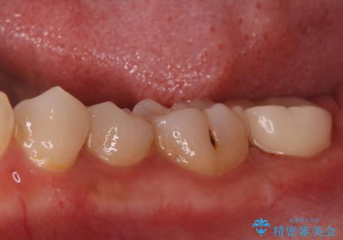 奥歯の激しい痛みを解消し、歯を長持ちさせる精密治療の治療後