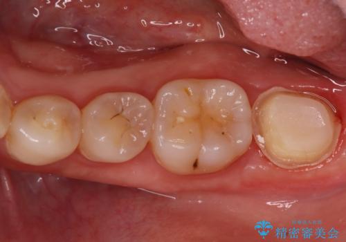 奥歯の激しい痛みを解消し、歯を長持ちさせる精密治療の治療中
