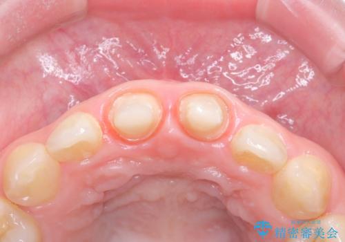 前歯の見た目と根の悩みを根本から解決の治療中