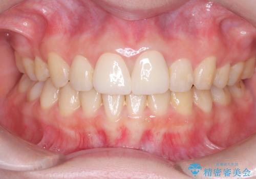 前歯の見た目と根の悩みを根本から解決の治療後