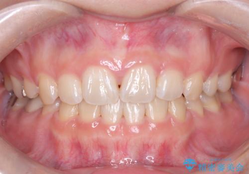 目立たない矯正で口元の突出感を解消の治療後