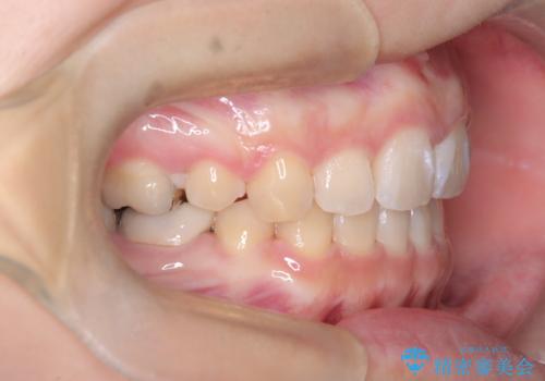 目立たない矯正で口元の突出感を解消の治療後