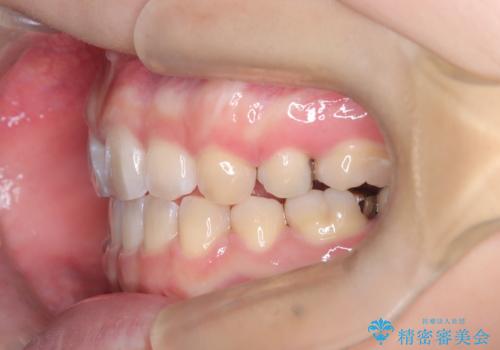目立たない矯正で口元の突出感を解消の治療後