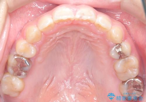 目立たない矯正で口元の突出感を解消の治療後