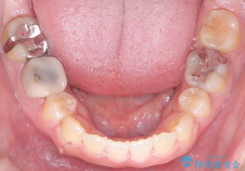 目立たない矯正で口元の突出感を解消の治療後