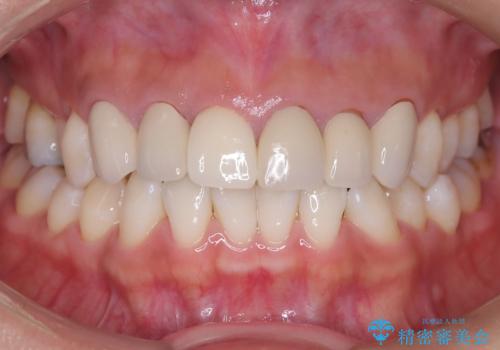 前歯の破折も1日で解決!抜歯即時インプラントで自然な笑顔への症例 治療後