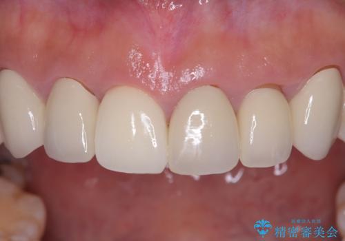 前歯の破折も1日で解決!抜歯即時インプラントで自然な笑顔への治療後