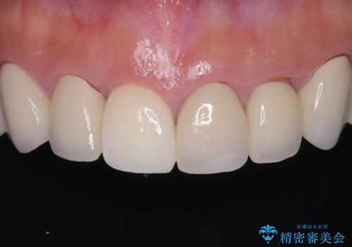 前歯の破折も1日で解決!抜歯即時インプラントで自然な笑顔への治療後
