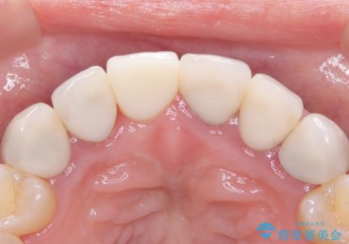 前歯の破折も1日で解決!抜歯即時インプラントで自然な笑顔への治療後
