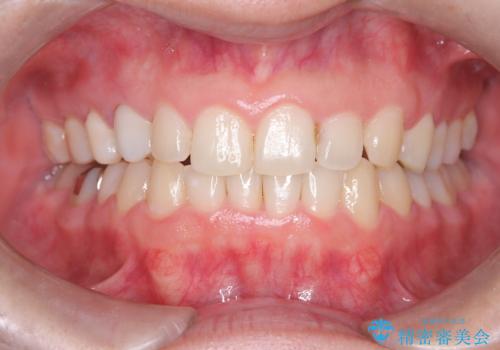 マウスピースで歯並びを改善の症例 治療後