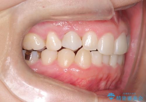 マウスピースで歯並びを改善の治療後