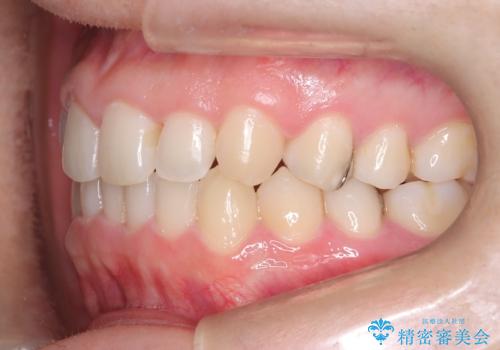 マウスピースで歯並びを改善の治療後