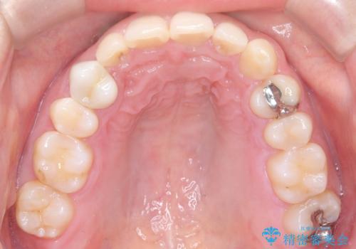 マウスピースで歯並びを改善の治療後