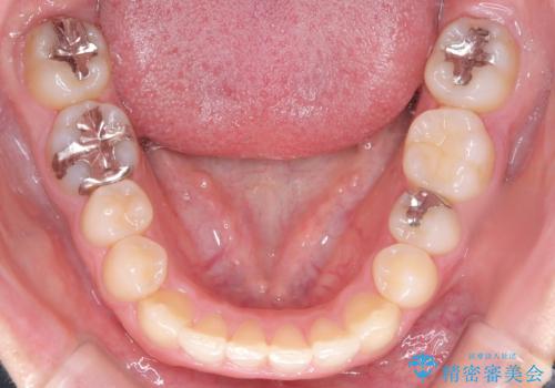 マウスピースで歯並びを改善の治療後