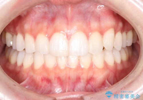 左の八重歯を、目立たないマウスピース矯正で改善の症例 治療後