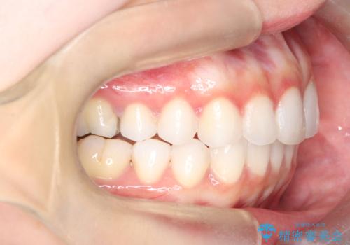 左の八重歯を、目立たないマウスピース矯正で改善の治療後