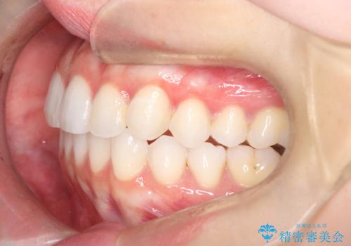 左の八重歯を、目立たないマウスピース矯正で改善の治療後