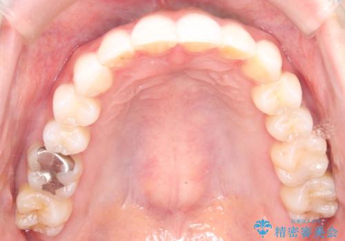 左の八重歯を、目立たないマウスピース矯正で改善の治療後