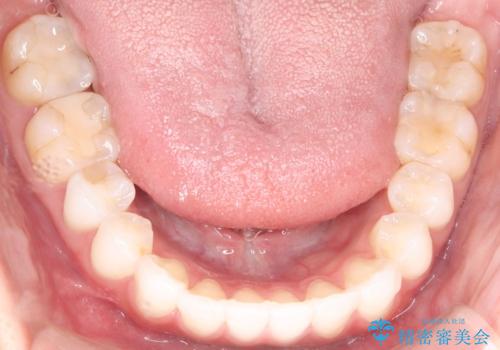 左の八重歯を、目立たないマウスピース矯正で改善の治療後