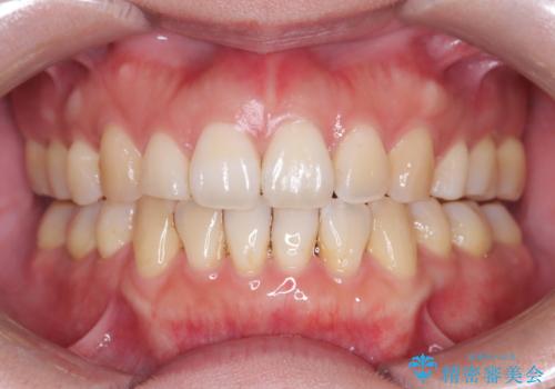 重度のデコボコも、インビザラインで改善の治療後