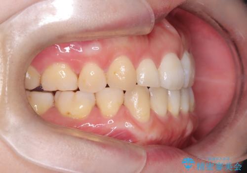 重度のデコボコも、インビザラインで改善の治療後