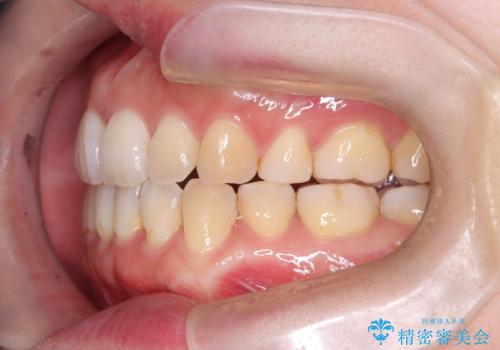 重度のデコボコも、インビザラインで改善の治療後