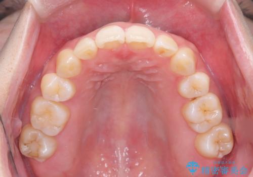 重度のデコボコも、インビザラインで改善の治療後