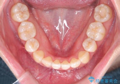 重度のデコボコも、インビザラインで改善の治療後