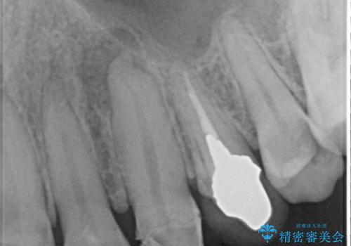 「抜歯してブリッジ」と言われた20代女性が選んだ治療とは?|たった4か月で自然な笑顔に|抜歯即時インプラント+審美補綴の症例の治療前