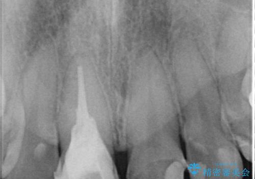 「抜歯してブリッジ」と言われた20代女性が選んだ治療とは?|たった4か月で自然な笑顔に|抜歯即時インプラント+審美補綴の症例の治療前