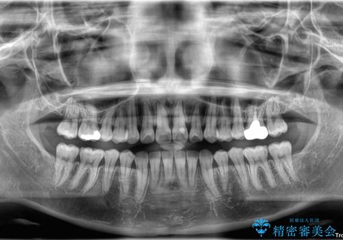 前歯のねじれ・ガタガタを10か月で改善!20代女性の矯正治療|クリアブラケットでむし歯になりにくい歯並びへ改善の治療後