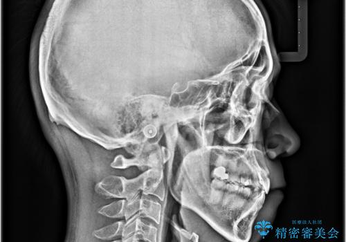 八重歯と前歯のガタガタを抜歯矯正で治療|クリアブラケット使用例の治療後