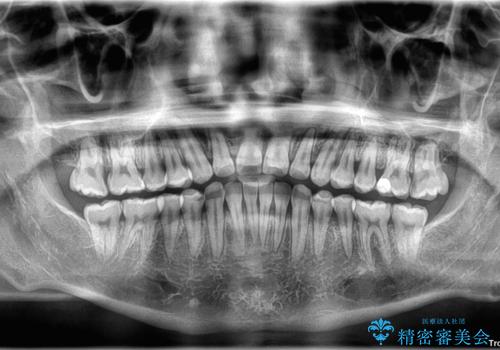 前歯のガタガタ・奥歯のかみ合わせ(シザーズバイト)を改善|1年半で完了したメタルブラケット矯正の治療後