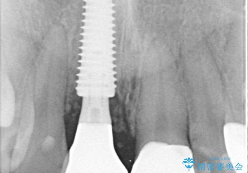 「抜歯してブリッジ」と言われた20代女性が選んだ治療とは?|たった4か月で自然な笑顔に|抜歯即時インプラント+審美補綴の症例の治療後