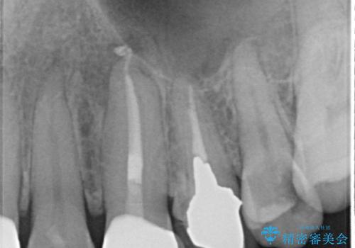 「抜歯してブリッジ」と言われた20代女性が選んだ治療とは?|たった4か月で自然な笑顔に|抜歯即時インプラント+審美補綴の症例の治療後