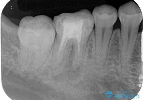 ラバーダム使用で再感染リスクを抑えた再根管治療+精密な補綴による長期安定を実現の治療前