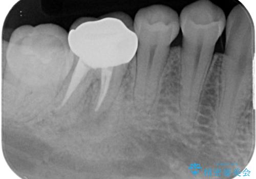 ラバーダム使用で再感染リスクを抑えた再根管治療+精密な補綴による長期安定を実現の治療後